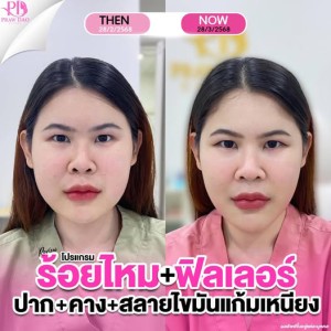 ประกาศ สินค้า เสริมความงามอุด ฉีดฟิลเลอร์อุดรธานี ลดริ้วรอย ยกกระชับ อุดร-ฉีดโบท็อก